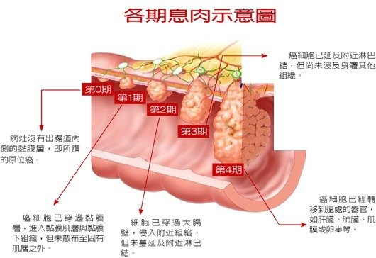 [健康]定期糞便檢查, 遠離大腸癌